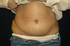Abdominoplasty2